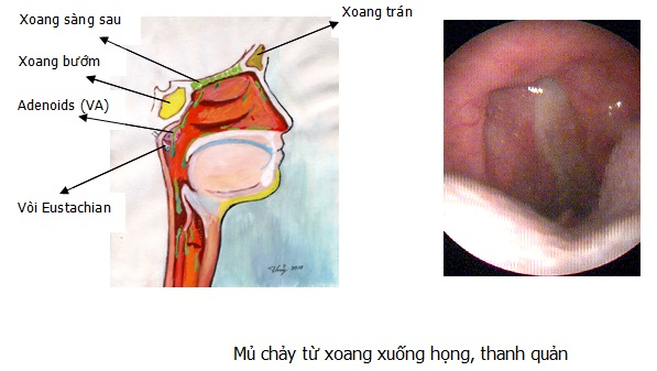 Hình ảnh X quang trong viêm mũi xoang mãn